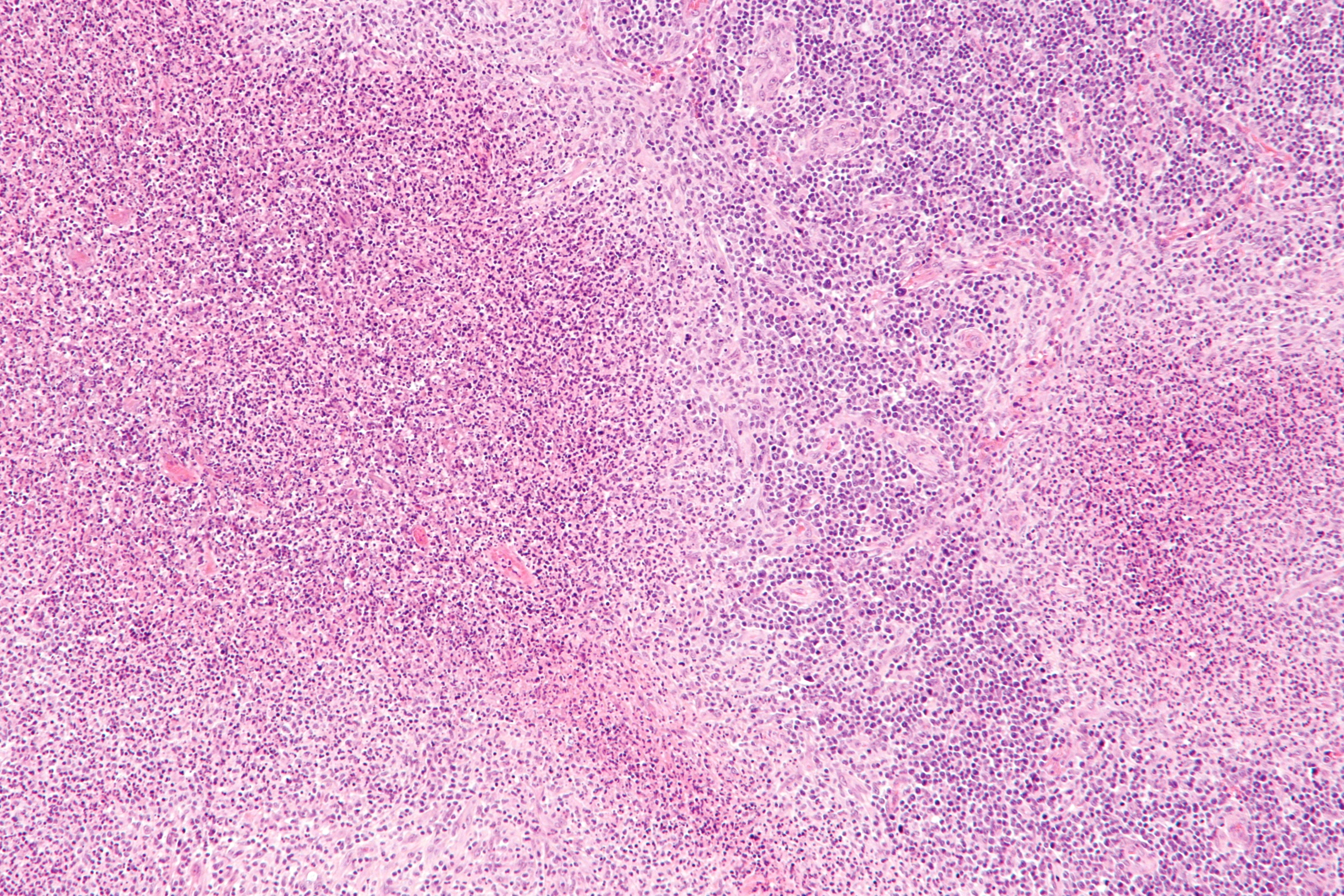 Bartonelosis felina